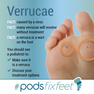 Verrucae #Podsfixfeet