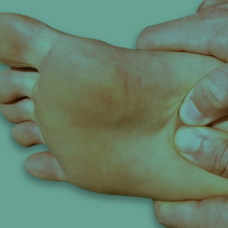 problems_plantar Pods Fix Feet